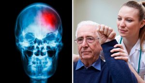 什麼是小中風?檢測的關鍵