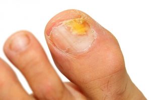 5種消除甲癬的精油