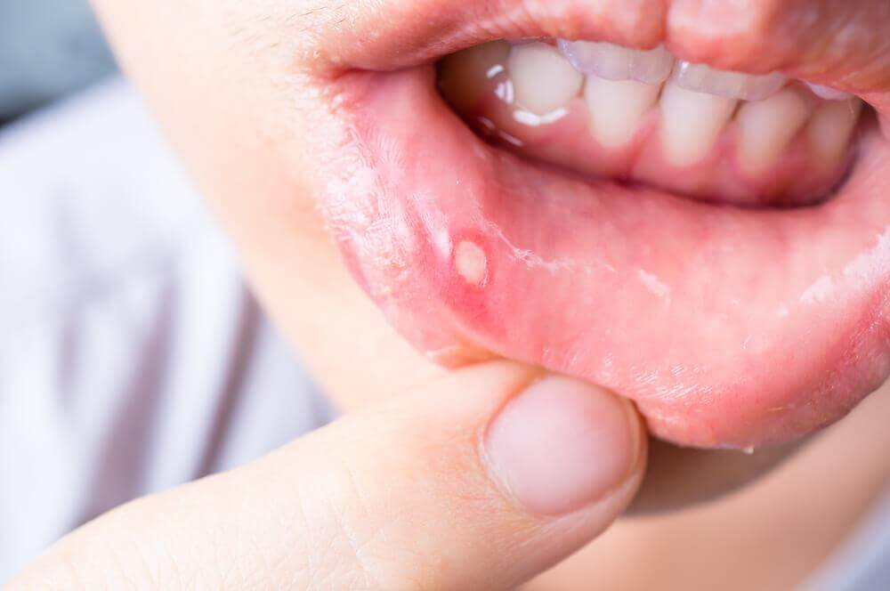 7種治療口腔潰瘍的自製療法