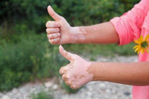 自體免疫疾病:哪些食物可吃,哪些食物應該避免