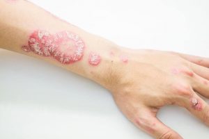 用這些自然療法對抗乾癬