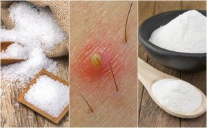 毛髮內生的5種天然解方