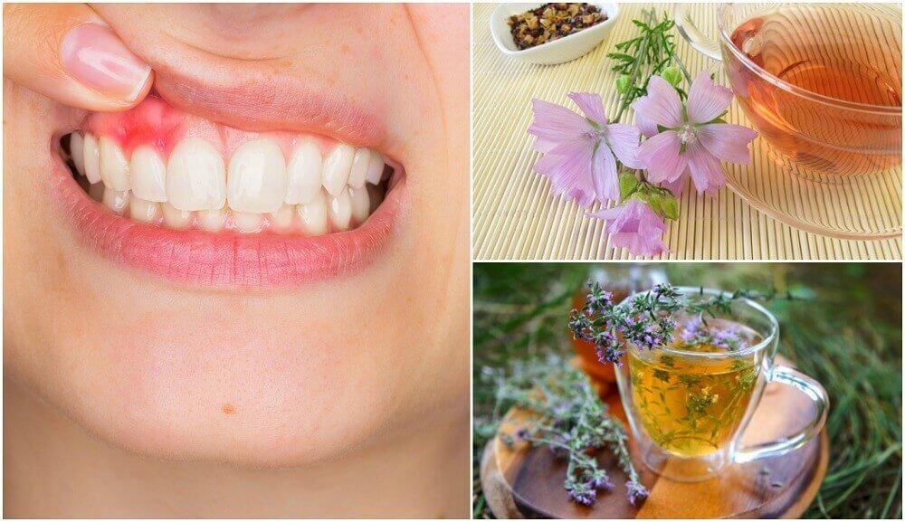 治療牙齦炎的5種自然療法