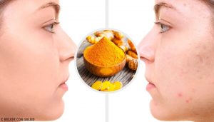 對付痘疤的5種薑黃面膜