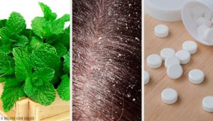 7種治療頭皮屑的居家療法