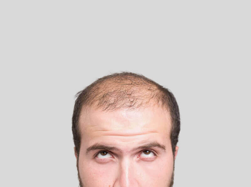 治療禿頭的三種自然療法