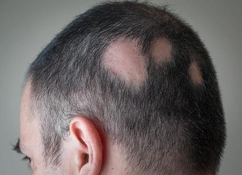 如何使用自然療法治療脫髮