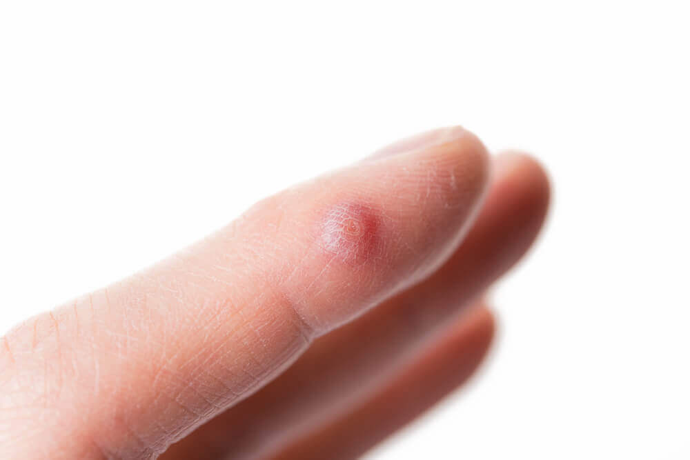 5種方法移除手指上的疣