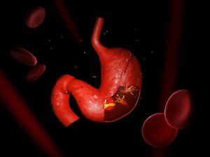 對抗幽門螺旋桿菌感染的草本療法