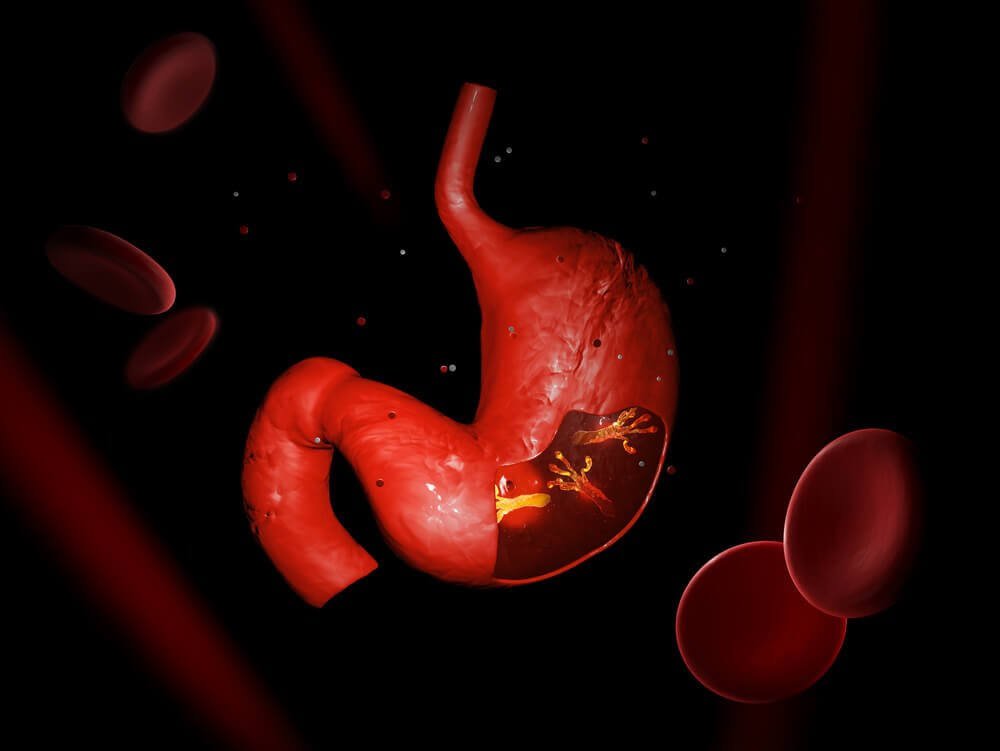 對抗幽門螺旋桿菌感染的草本療法