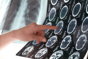 協助你預防中風的６項祕訣