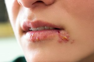 如何治療兒童疱疹