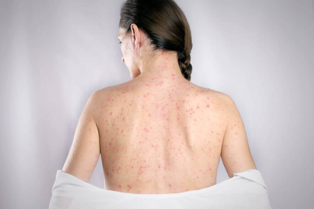治療背部疱疹的５種最佳療方