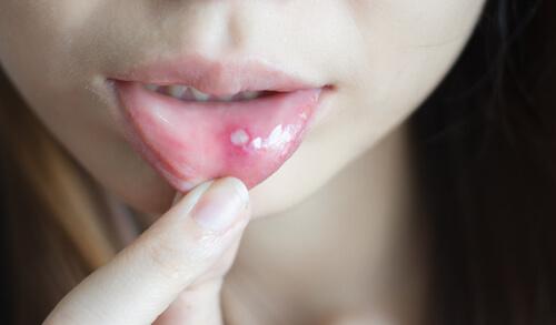 口腔潰瘍該如何治療？