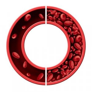 五種自然療法治療缺鐵性貧血