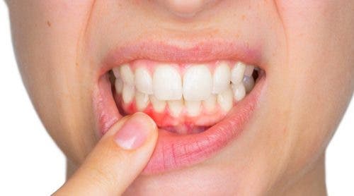 牙齦膿腫及其治療