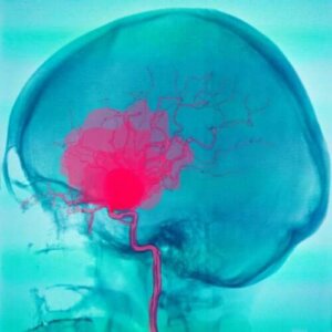 蜘蛛網膜和硬腦膜下腔出血