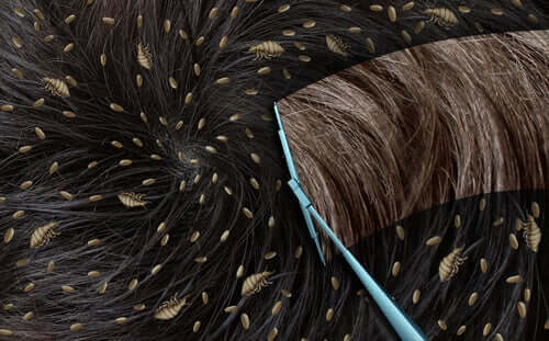 快速去除頭蝨卵