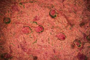 腎結核的診斷與治療