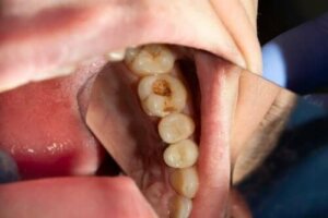 齲齒:蛀牙的原因是什麼?