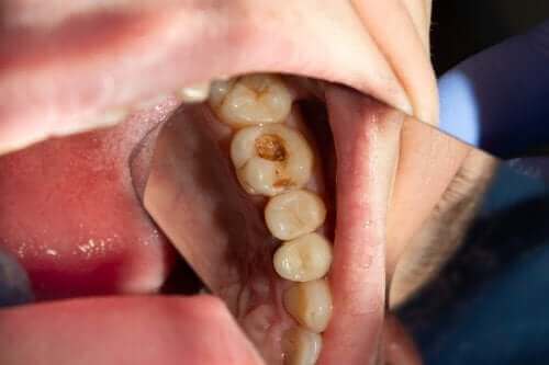 齲齒：蛀牙的原因是什麼？
