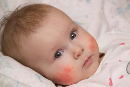嬰兒的皮膚炎