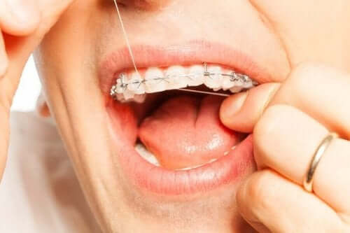牙齒矯正時使用牙線