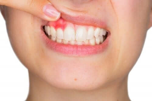女人牙齦腫脹