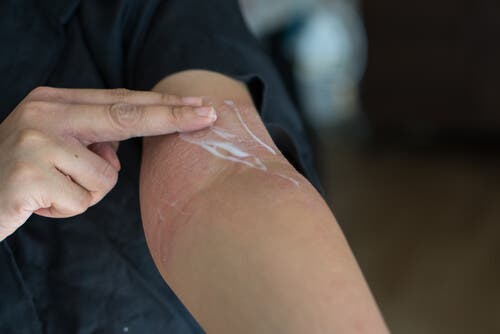 一個人使用外用皮質類固醇在手臂上