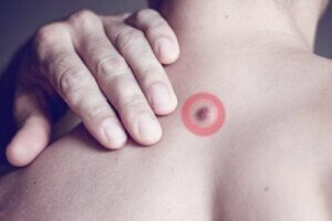 背部脂肪硬塊的成因