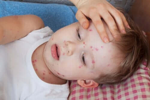 如何治療兒童蕁麻疹