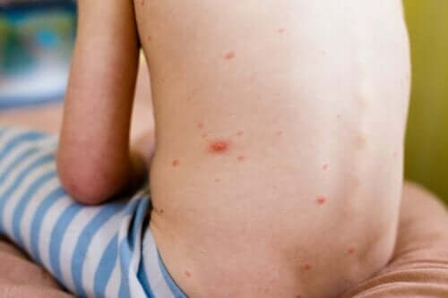 兒童蕁麻疹