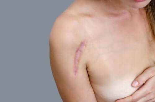 女性肩膀疤痕